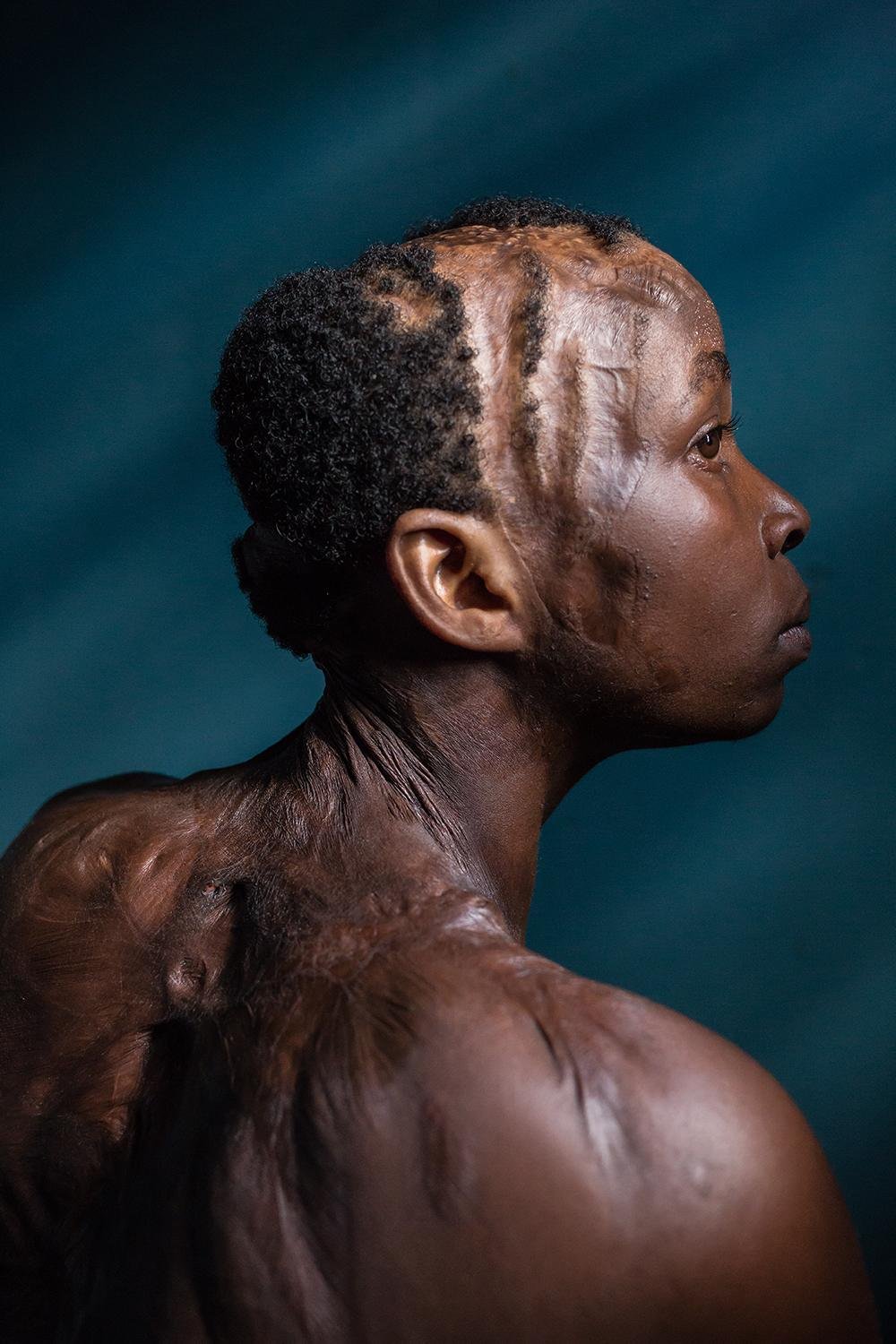 Lynette, acid attack survivor by Erberto Zani